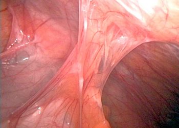 Beware of Hysterectomy Adhesions and How to Spot Them