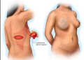 breast reconstruction